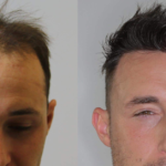 FUE Hair Transplant: A Revolutionary Method for Restoring Your Hairline