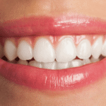porcelain veneer