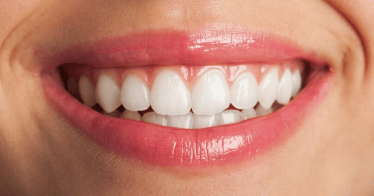 porcelain veneer