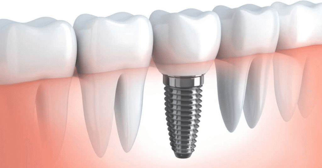 screw in teeth