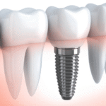 screw in teeth