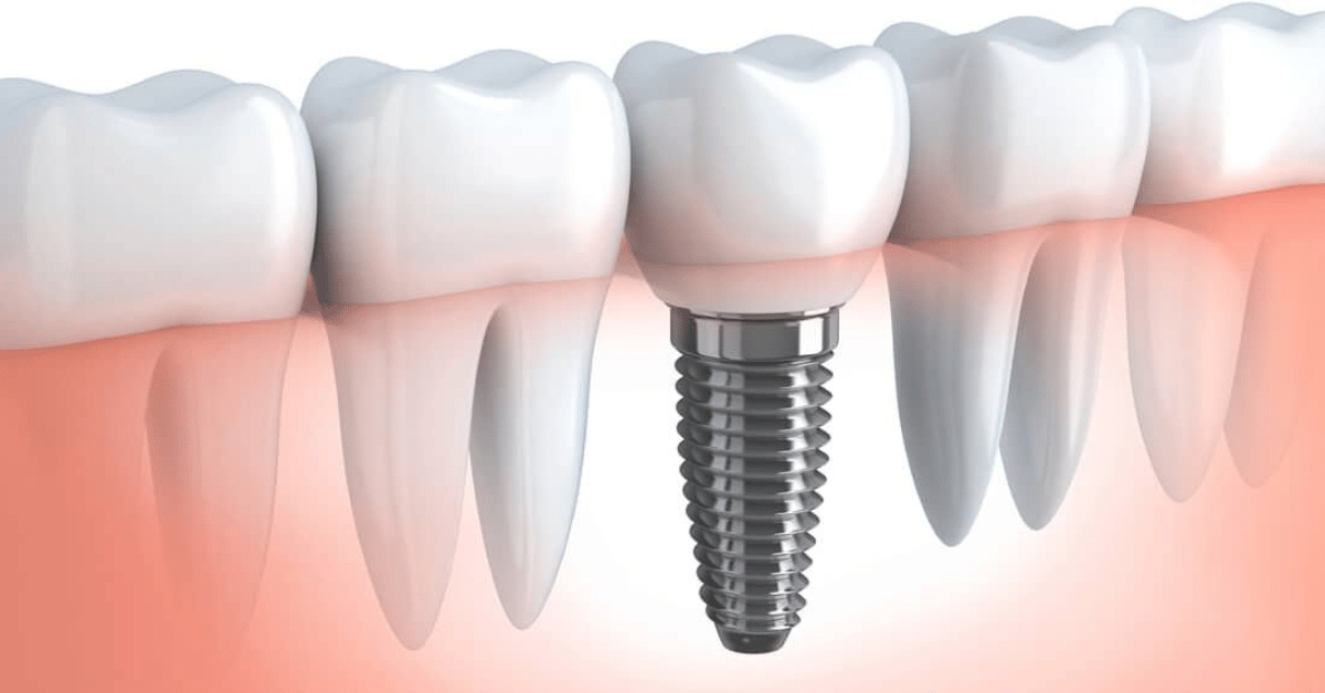 screw in teeth