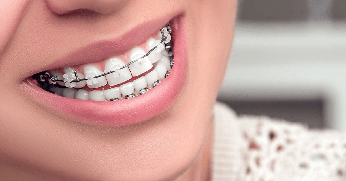ceramic braces